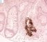 Adenoviral colonic infections