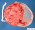 Normal amniotic membrane around the placenta