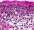 Botryoid embryonal rhabdomyosarcoma of the rhinopharynx