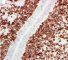 Botryoid embryonal rhabdomyosarcoma of the rhinopharynx (Desmin)