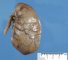 Colonic atresia