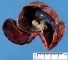 Hemorrhagic amniotic sac with embryo