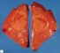Focal nodular hyperplasia in sickle cell anemia