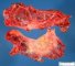 Splenic mesothelial cyst (open)