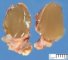 Thyroglossal tract cyst