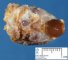 Thyroglossal tract cyst