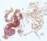 Vas deferens and epididymal duplication
