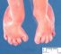 Metatarsus adductus and tarsus valgus in acampomelic campomelic dysplasia (...)