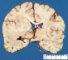 Periventricular cortical heterotopia