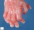 Pre-axial polydactyly