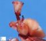Right pulmonary agenesis