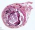 Tubar pregnancy