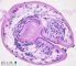 hydatid cyst : protoscolex and hooklets