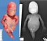 Caudal regression syndrome with sirenomelia unipus