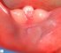 Vaginal atresia and sexual ambiguity in caudal regression syndrome with (...)