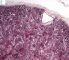 Fetal oligocystic kidneys of unknow cause (case 11389)
