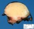 Pelvic intermixed ganglioneuroblastoma (Case 11543)