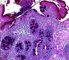 Intestinal metaplasia in stomach (ABPAS)