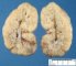 ARPKD kidney in a neonate (1 month)