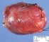 clear cell myomelanocytic tumor of falciform ligament