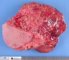 Hypodermal cystic lymphangioma