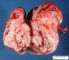 Intra-abdominal immature teratoma