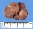 Colorectal juvenile polyp