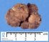 Colorectal juvenile polyp
