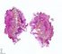 Lingual lymphangioma