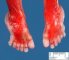 Post-axial polydactyly in Meckel syndrome