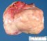 Ovarian fibrothecoma