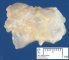 Popliteal synovial cyst