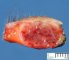 Lobular capillary hemangioma