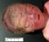 Low anterior hairline (28 weeks)