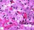 Parvoviral inclusion in fetal liver (hydrops fetalis)