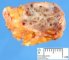 Subcutaneous endometriosis
