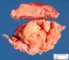 Thymic seminoma