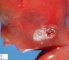 Microtia in trisomy 13