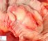 Colonic GIST under colonic mucosa