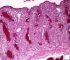 Intestinal cystic fibrosis with villous atrophy