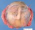 Fetus in amniotic sac - 20 weeks