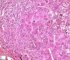 Massive hepatic necrosis in fulminant auto-immune hepatitis