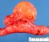 Intestinal lymphangioma