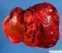 Hepatic ischemia in a liver allograft