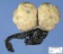 Testicular endodermal sinus tumor (Yolk sac tumor)