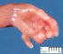 Post-axial polydactyly in Meckel syndrome