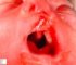 Cleft palate in malformative syndrome