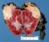 Wilms tumor