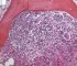 Juxta-trabecular neuroblastic nodule
