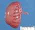Colonic atresia